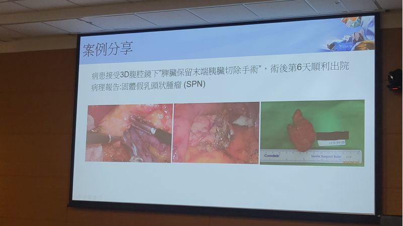 成大醫院一般外科呂維勛醫師分享 解密胰臟囊腫:如何診斷和治療? 圖片來源:記者林清雲 成大醫院一般外科呂維勛醫師分享 解密胰臟囊腫:如何診斷和治療? 圖片來源:記者林清雲
