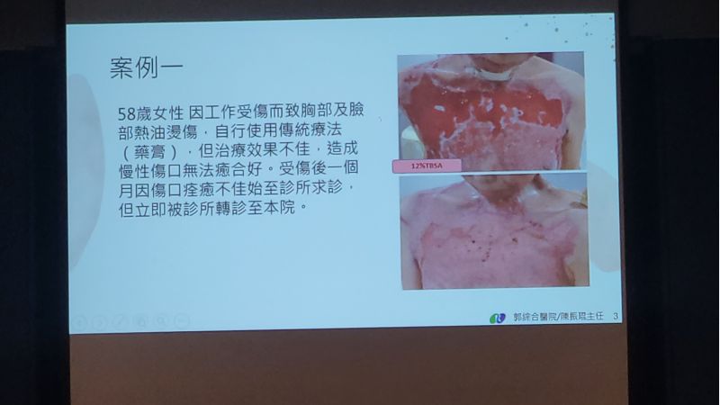 高濃度血小板血高漿PRP---促進困難及慢性能傷口癒合 郭綜合醫院整型外科主任/陳振琨主治 圖片來源:記者林清雲 高濃度血小板血高漿PRP---促進困難及慢性能傷口癒合 郭綜合醫院整型外科主任/陳振琨主治 圖片來源:記者林清雲