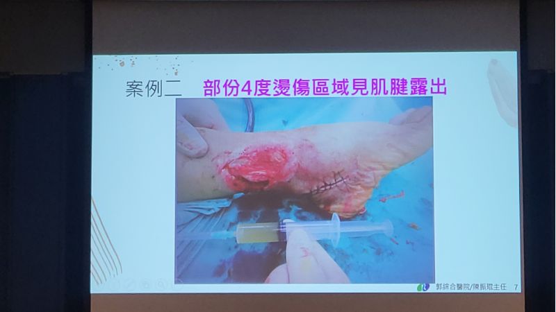 高濃度血小板血高漿PRP---促進困難及慢性能傷口癒合 郭綜合醫院整型外科主任/陳振琨主治 圖片來源:記者林清雲 高濃度血小板血高漿PRP---促進困難及慢性能傷口癒合 郭綜合醫院整型外科主任/陳振琨主治 圖片來源:記者林清雲