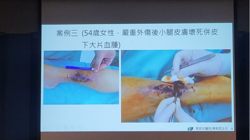 高濃度血小板血高漿PRP---促進困難及慢性能傷口癒合 郭綜合醫院整型外科主任/陳振琨主治 圖片來源:記者林清雲 高濃度血小板血高漿PRP---促進困難及慢性能傷口癒合 郭綜合醫院整型外科主任/陳振琨主治 圖片來源:記者林清雲