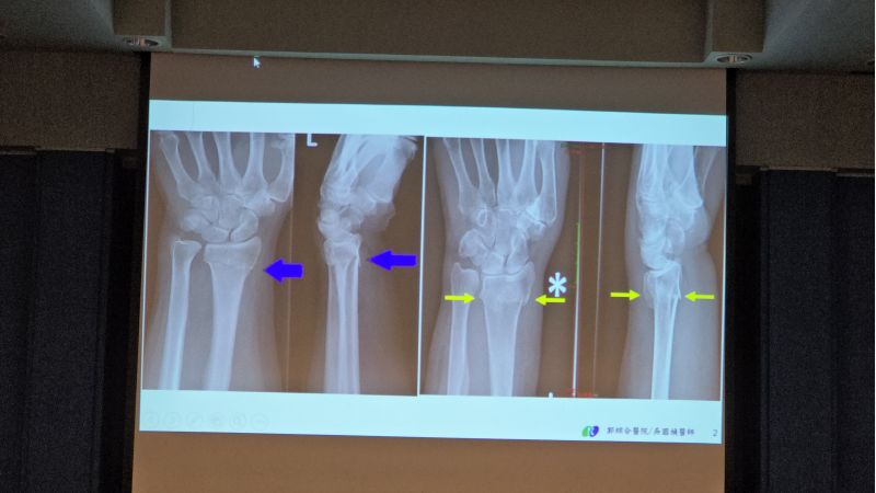 郭綜合醫院骨科主任 吳國禎主治醫師分享 圖片來源:記者 林清雲 攝 郭綜合醫院骨科主任 吳國禎主治醫師分享 圖片來源:記者 林清雲 攝