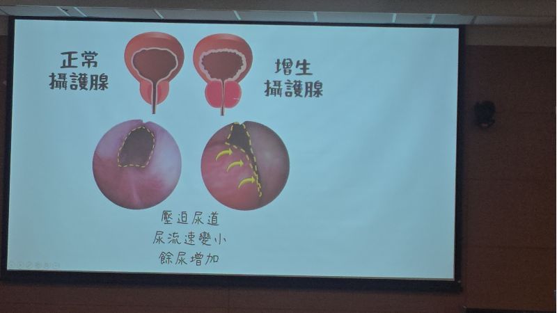 成大醫院泌尿部謝宜珈醫師分享案例  圖片來源：記者林清雲攝